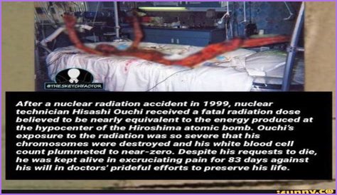The Devastating Aftermath: Hisashi Ouchi's Autopsy Reveals Extent Of Radiation Damage